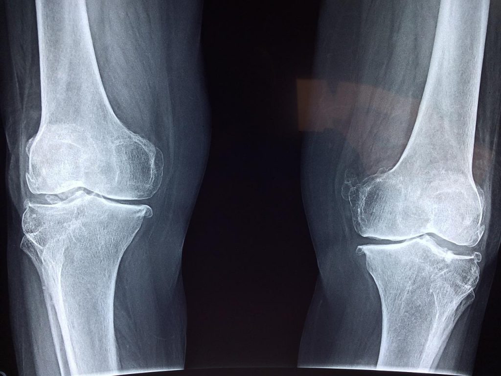 Efficacy of methylsulfonylmethane supplementation on osteoarthritis of the knee: a randomized controlled study